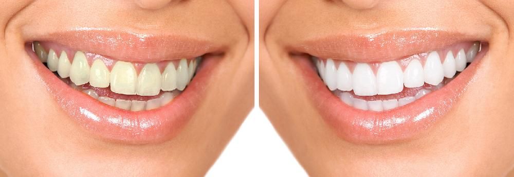 Отбеливание зубов с помощью клинической лампы Zoom III