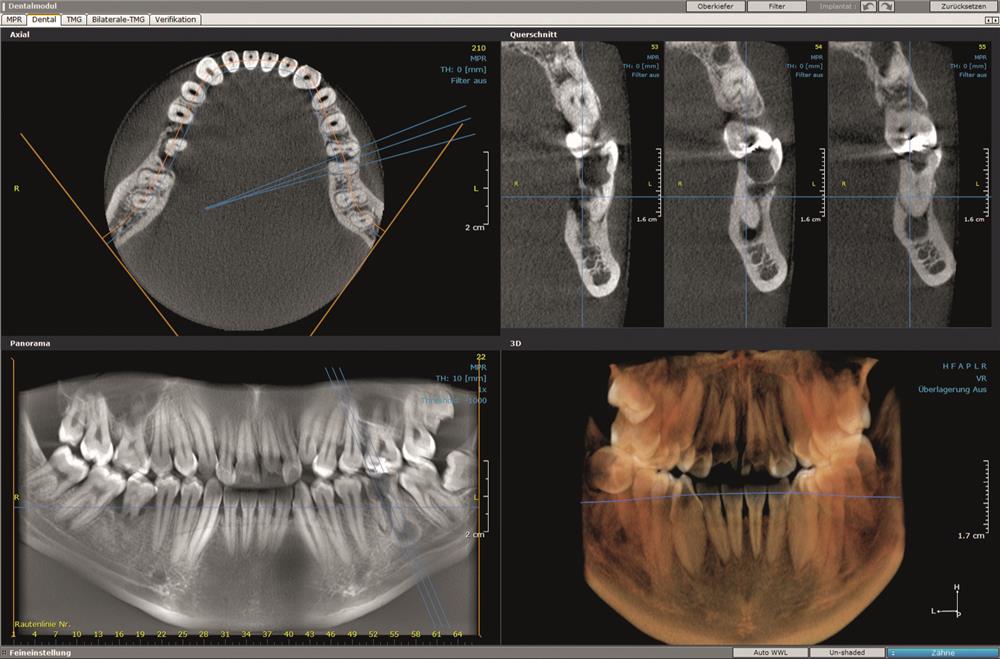 Томограф Orthopantomograph KAVO OP 3D Pro Ceph область 3D сканирования 13x15 см - Instrumentarium Dental, PaloDEx Group Oy