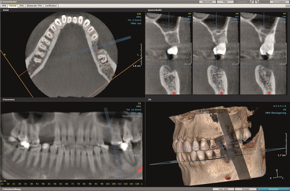 Томограф Orthopantomograph DEXIS OP 3D Pro Ceph область 3D сканирования 13x15 см с цефалостатом - Instrumentarium Dental, PaloDEx Group Oy