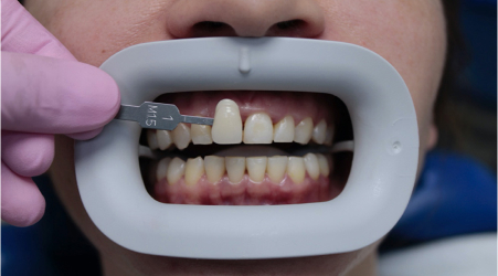 Этапы отбеливания зубов Flash - Определение цвета зубов пациента до процедуры отбеливания