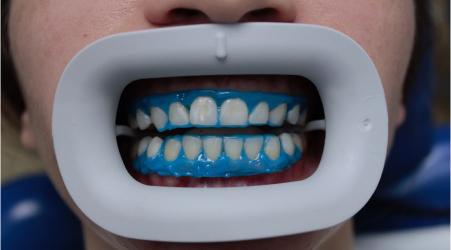 Этапы отбеливания зубов Flash - Изоляция рабочего поля для безопасного проведения процедуры отбеливания зубов