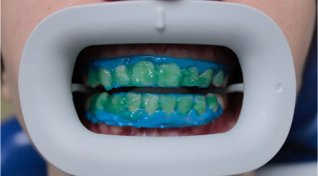 Этапы отбеливания зубов Flash - Нанесение отбеливающего геля на поверхность зубов