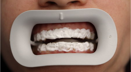 Этапы отбеливания зубов Flash - Активация отбеливающего геля