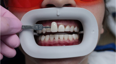 Этапы отбеливания зубов Flash - Определение цвета зубов пациента после процедуры отбеливания