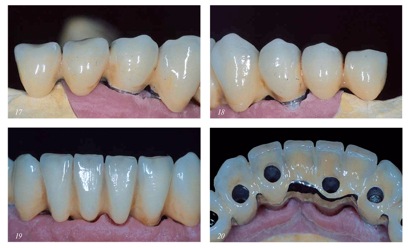 Сплавы стоматология