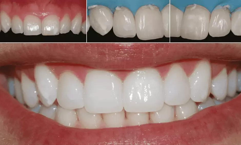 Inspiro результат реставрации зубов