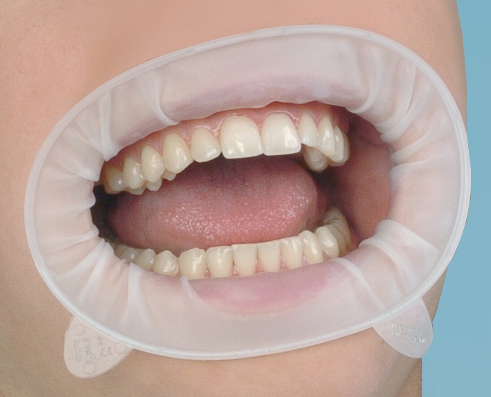 Стоматорг - Роторасширитель OptraGate (Regular) Рефил 80 шт. - ретрактор для губ.